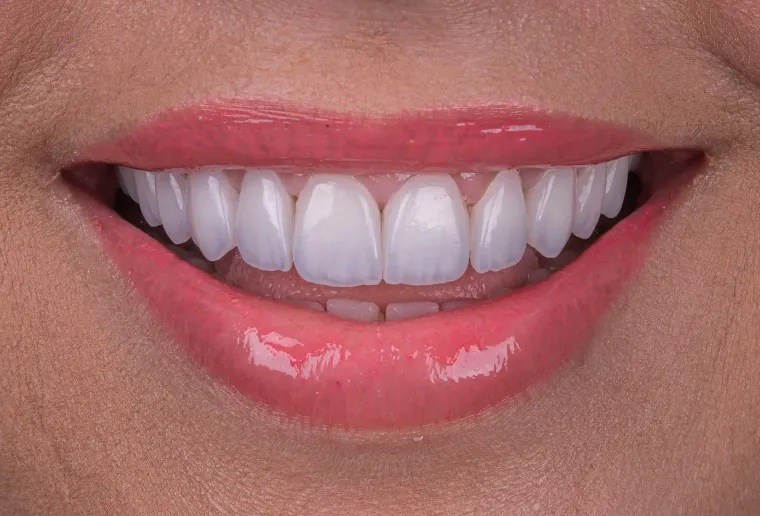 Facetas de porcelana