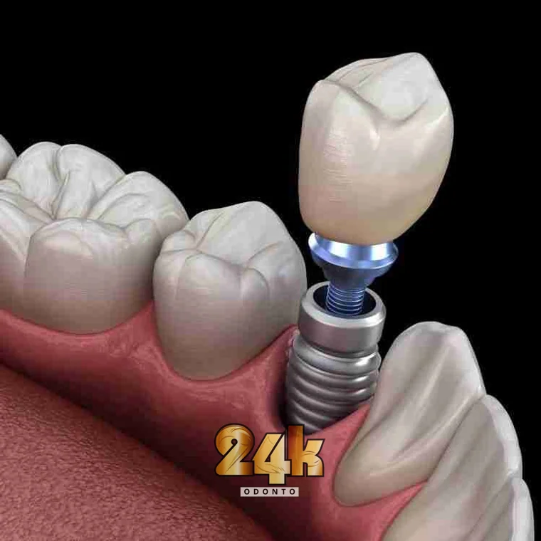 Implante dentário unitário