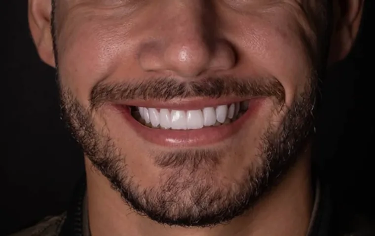 Facetas e Lentes — Gabriel, imagem 2