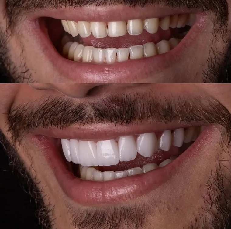 Facetas e Lentes — Gabriel, imagem 4