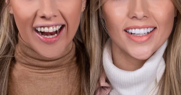Facetas e Lentes — Sabrina, imagem 1
