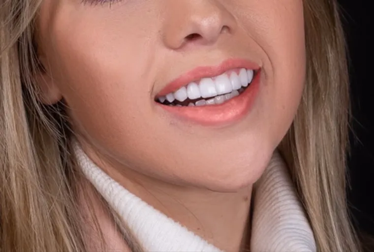Facetas e Lentes — Sabrina, imagem 2