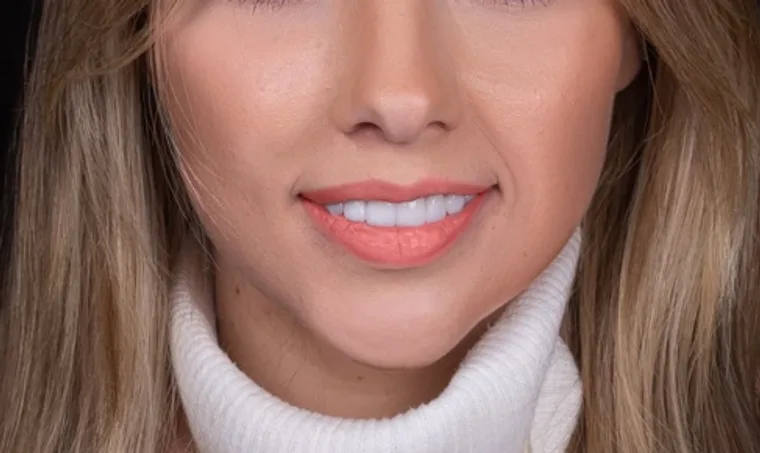 Facetas e Lentes — Sabrina, imagem 4