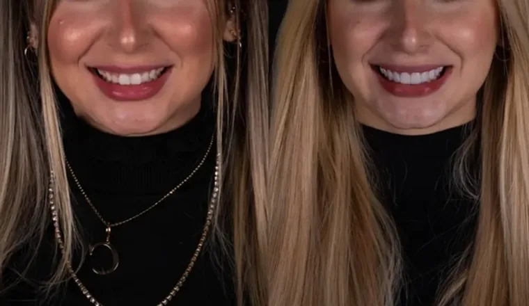 Facetas e Lentes — Rebeca, imagem 1