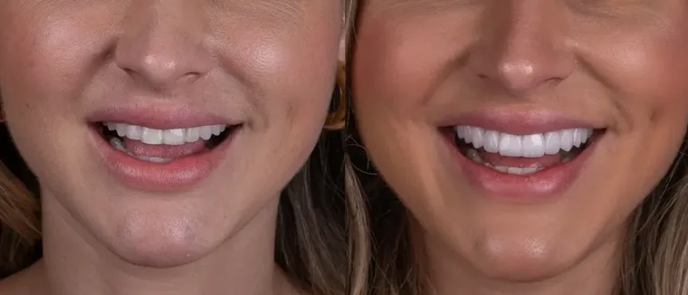 Facetas e Lentes — Patricia, imagem 1