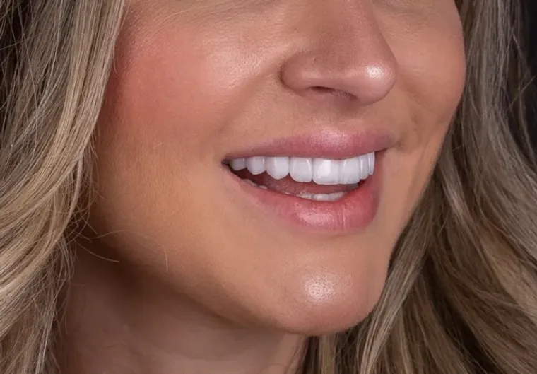 Facetas e Lentes — Patricia, imagem 2