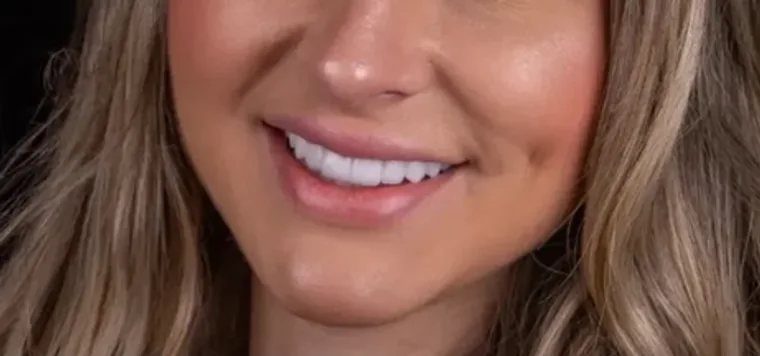 Facetas e Lentes — Patricia, imagem 4