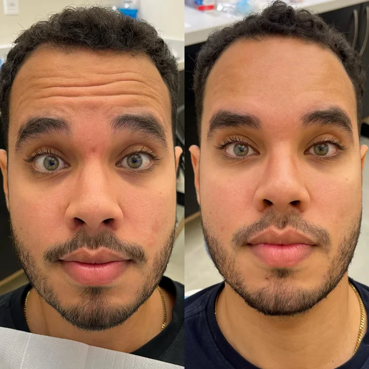 Botox e suavização