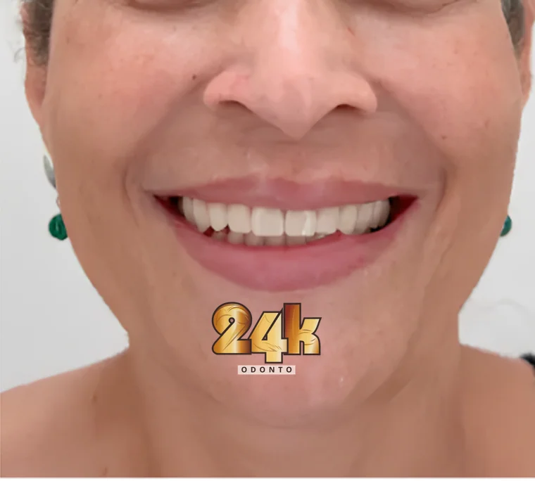 Torres — reabilitação completa