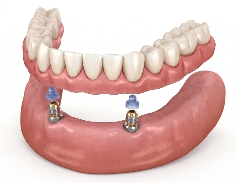 Overdenture