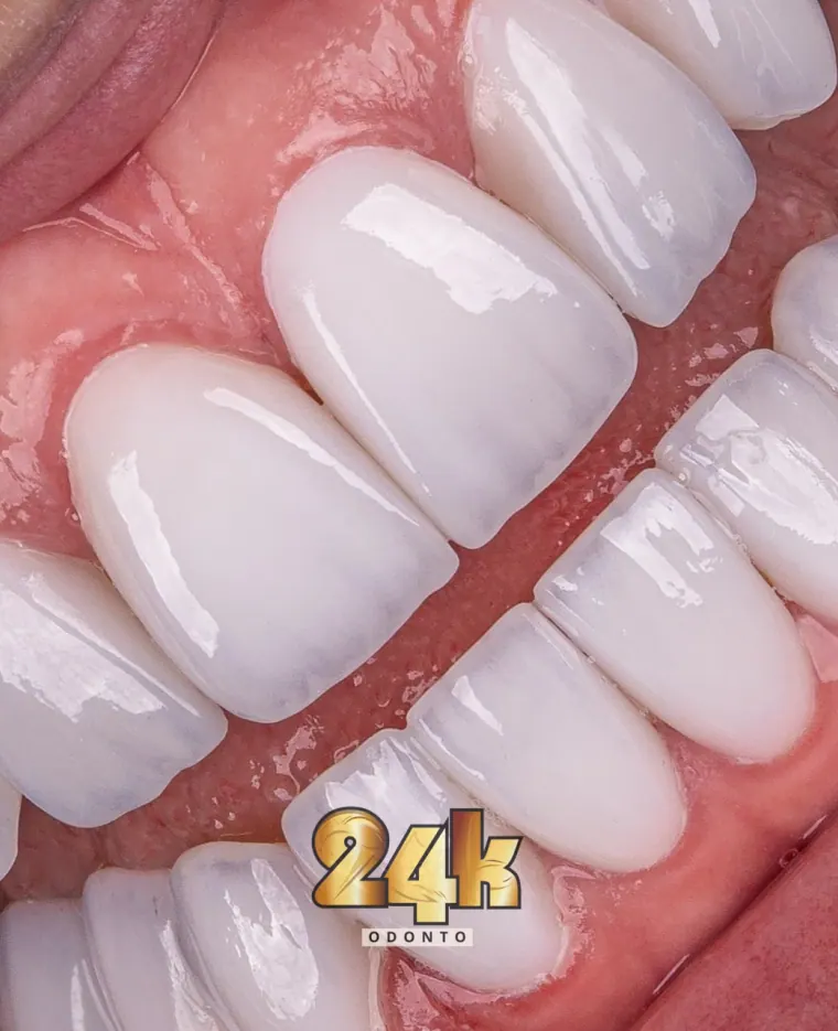 Facetas de Porcelana para Desgaste Dentário Severo: A Solução Restauradora que Transforma Sorrisos