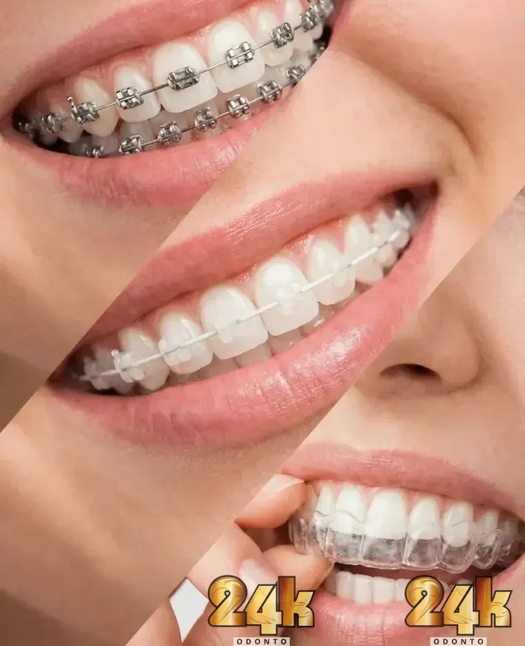 Invisalign®: O Futuro da Ortodontia é Transparente e Confortável